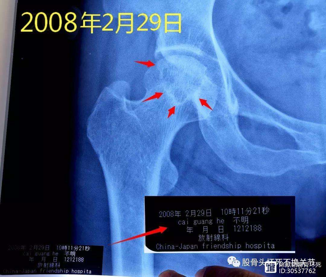 云浮人工骨头医保报销多少(人工骨头医保报销多少比例)